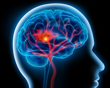 Coneguem les malalties cerebrovasculars: l’Ictus o infart cerebral